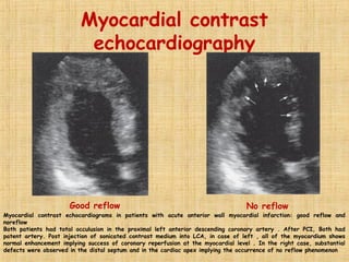 Myocardial contrast
echocardiography
Good reflow No reflow
Myocardial contrast echocardiograms in patients with acute anterior wall myocardial infarction: good reflow and
noreflow
Both patients had total occulusion in the proximal left anterior descending coronary artery . After PCI, Both had
patent artery. Post injection of sonicated contrast medium into LCA, in case of left , all of the myocardium shows
normal enhancement implying success of coronary reperfusion at the myocardial level . In the right case, substantial
defects were observed in the distal septum and in the cardiac apex implying the occurrence of no reflow phenomenon
 