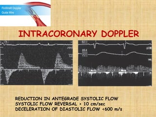 REDUCTION IN ANTEGRADE SYSTOLIC FLOW
SYSTOLIC FLOW REVERSAL > 10 cm/sec
DECELERATION OF DIASTOLIC FLOW <600 m/s
INTRACORONARY DOPPLER
 