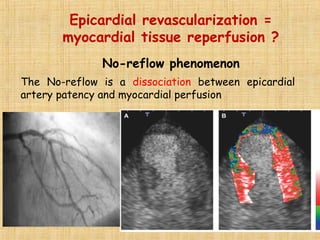 No-reflow phenomenon
Epicardial revascularization =
myocardial tissue reperfusion ?
The No-reflow is a dissociation between epicardial
artery patency and myocardial perfusion
 