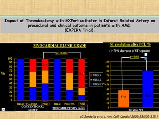 Impact of Thrombectomy with EXPort catheter in Infarct Related Artery on
procedural and clinical outcome in patients with AMI
(EXPIRA Trial).
(G.Sardella et al J. Am. Coll. Cardiol 2009;53;309-315 )
TGCG
TG
CG
 