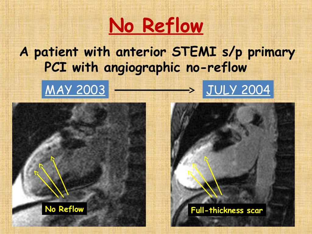 no reflow phenomenon no reflow phenomenon