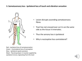 3. Somatosensory loss - ipsilateral loss of touch and vibration sensation
Red – Ipsilateral loss of somatosensation
Green ...