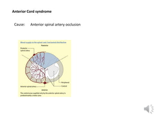 Anterior Cord syndrome
Cause: Anterior spinal artery occlusion
 