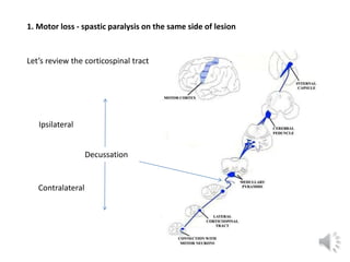 1. Motor loss - spastic paralysis on the same side of lesion
Let’s review the corticospinal tract
Decussation
Contralatera...