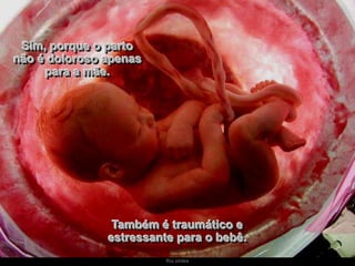 Sim, porque o parto
não é doloroso apenas
para a mãe.

Também é traumático e
estressante para o bebê.
Ria slides

 