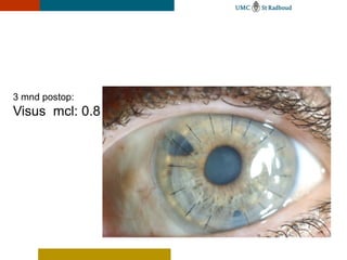 3 mnd postop:
Visus mcl: 0.8
 