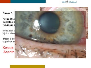 Casus 3

het rechter oog van
dezelfde patiënte met
fusarium solani !!

sinds paar dagen
pijn/roodheid/visusdaling

draagt cl ook in het rechter
oog sinds scleralens links

Kweek:
Acanthamoeba!
 