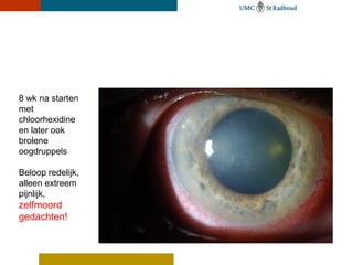 8 wk na starten
met
chloorhexidine
en later ook
brolene
oogdruppels

Beloop redelijk,
alleen extreem
pijnlijk,
zelfmoord
gedachten!
 