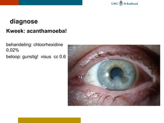 diagnose
Kweek: acanthamoeba!

behandeling: chloorhexidine
0,02%
beloop: gunstig! visus cc 0.6
 