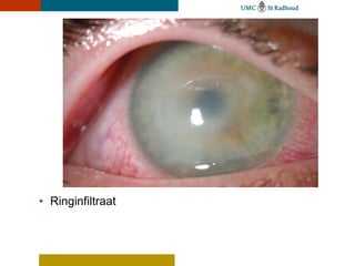 • Ringinfiltraat
 