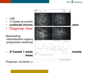 •   LAB:
•   1e kweek op acanthamoeba negatief
• confocale microscopie : multipele hyperdense cysten
• Diagnose: Acanthamoeba keratitis

Behandeling:
-chloorhexidine oogdruppels 0,02% 8dd (biguaniden)
-propamidine isothionate 1% oogdruppels (Brolene) 8dd


• 2e kweek 1 week later: positief voor acanthamoebe
             kweek op schimmels negatief

Prognose: vrij slecht, t.z.t cornea transplantatie
 