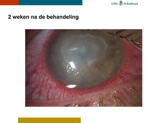 2 weken na de behandeling
 