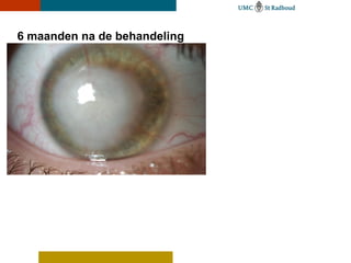 6 maanden na de behandeling
 