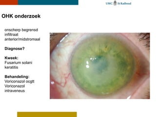 OHK onderzoek

 onscherp begrensd
 infiltraat
 anterior/midstromaal

 Diagnose?

 Kweek:
 Fusarium solani
 keratitis

 Behandeling:
 Voriconazol ocgtt
 Voriconazol
 intraveneus
 