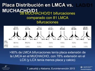 Placa Distribución en LMCA vs.
MUCHACHO/D1
58 MUCHACHO/D1 bifurcaciones
comparado con 81 LMCA
bifurcaciones
Espacial Distribución de Placa en Bifurcaciones
>90% de LMCA bifurcaciones tenía placa extensión de
la LMCA en el MUCHACHO, con 78% extensión en el
LCX (y LCX tenía menos placa y calcio)
T. yakushiji y Alabama, Eurointervención 2013
 