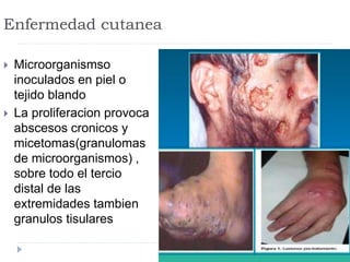 Enfermedad cutanea
 Microorganismso
inoculados en piel o
tejido blando
 La proliferacion provoca
abscesos cronicos y
micetomas(granulomas
de microorganismos) ,
sobre todo el tercio
distal de las
extremidades tambien
granulos tisulares
 
