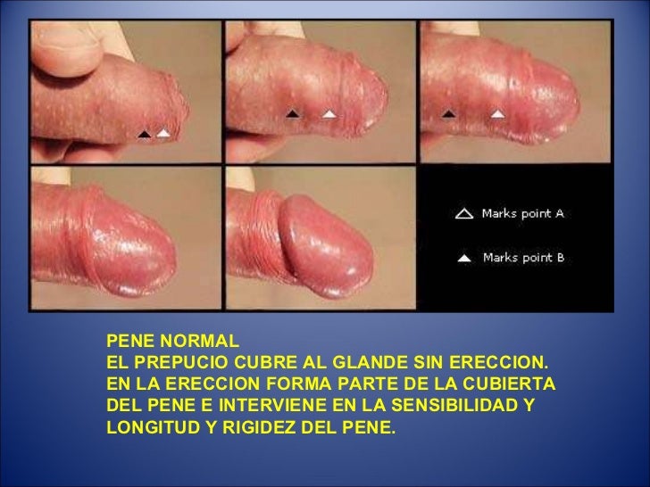 Que es necesario hacer para el aumento del pene