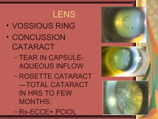 LENS
• VOSSIOUS RING
• CONCUSSION
CATARACT
– TEAR IN CAPSULE-
AQUEOUS INFLOW
– ROSETTE CATARACT
—TOTAL CATARACT
IN HRS TO FEW
MONTHS.
– Rx-ECCE+ PCIOL
 