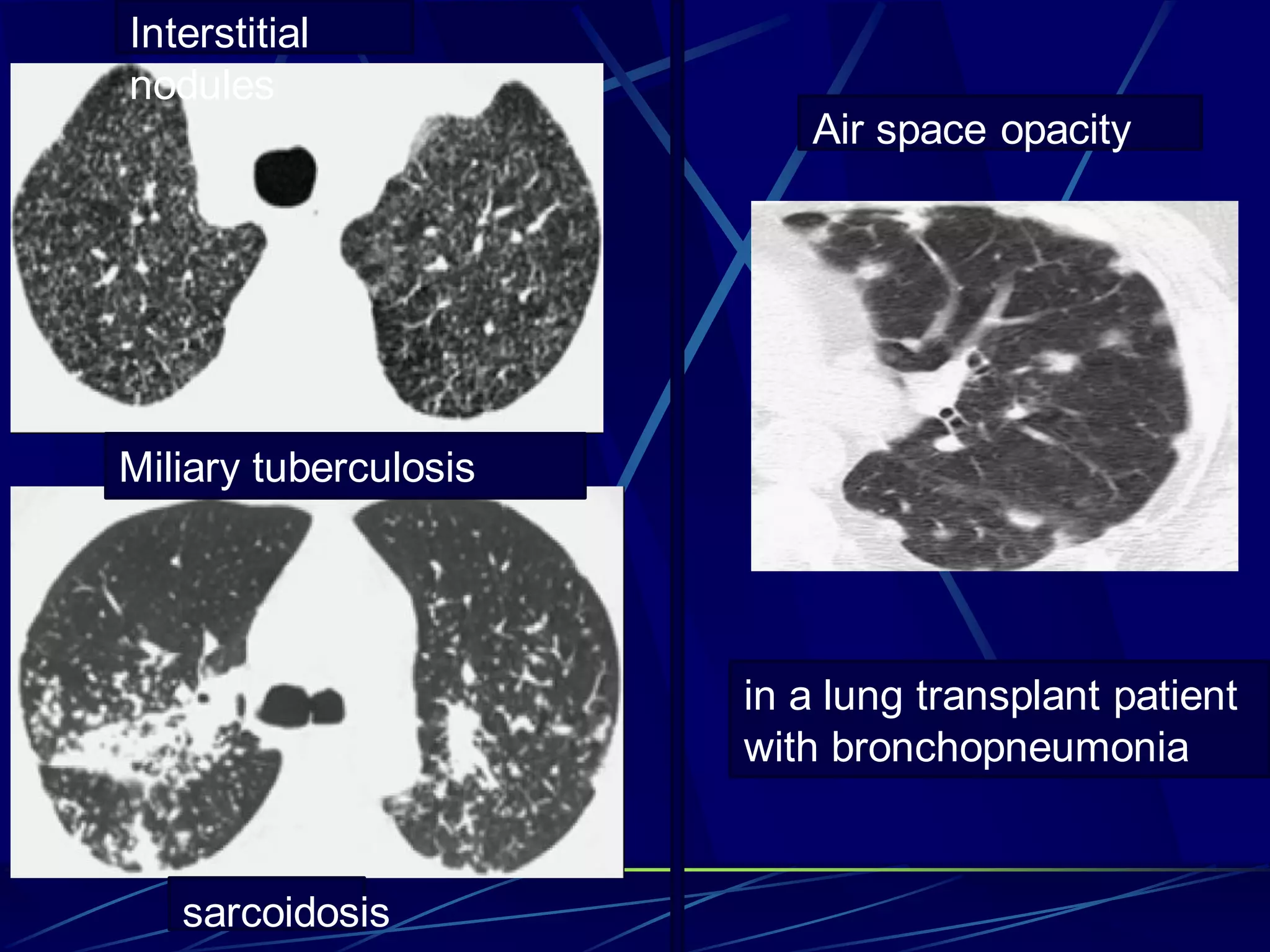 Interstitial
nodules
Air space opacity
Miliary tuberculosis
sarcoidosis
in a lung transplant patient
with bronchopneumonia
 