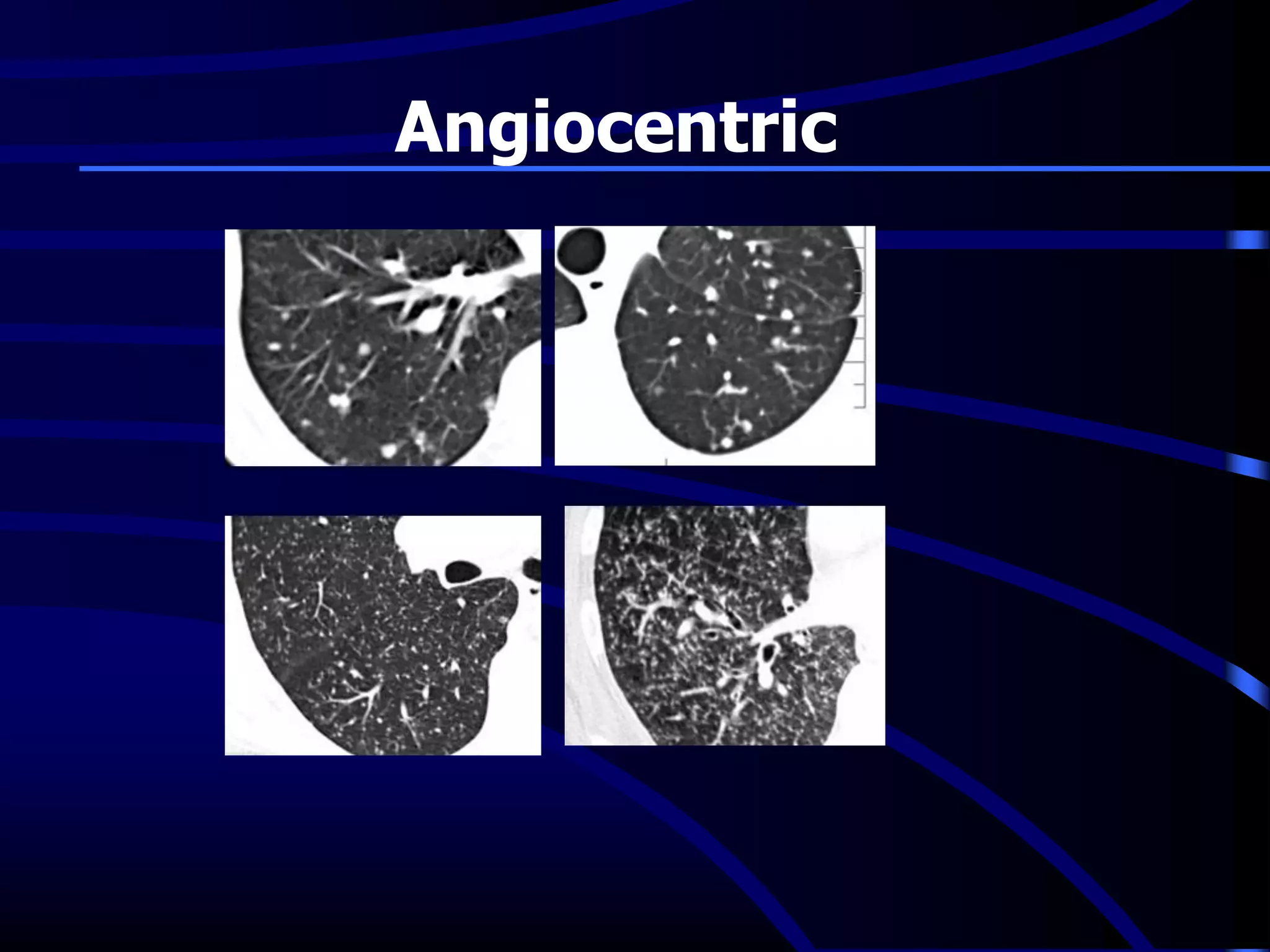 Angiocentric
 