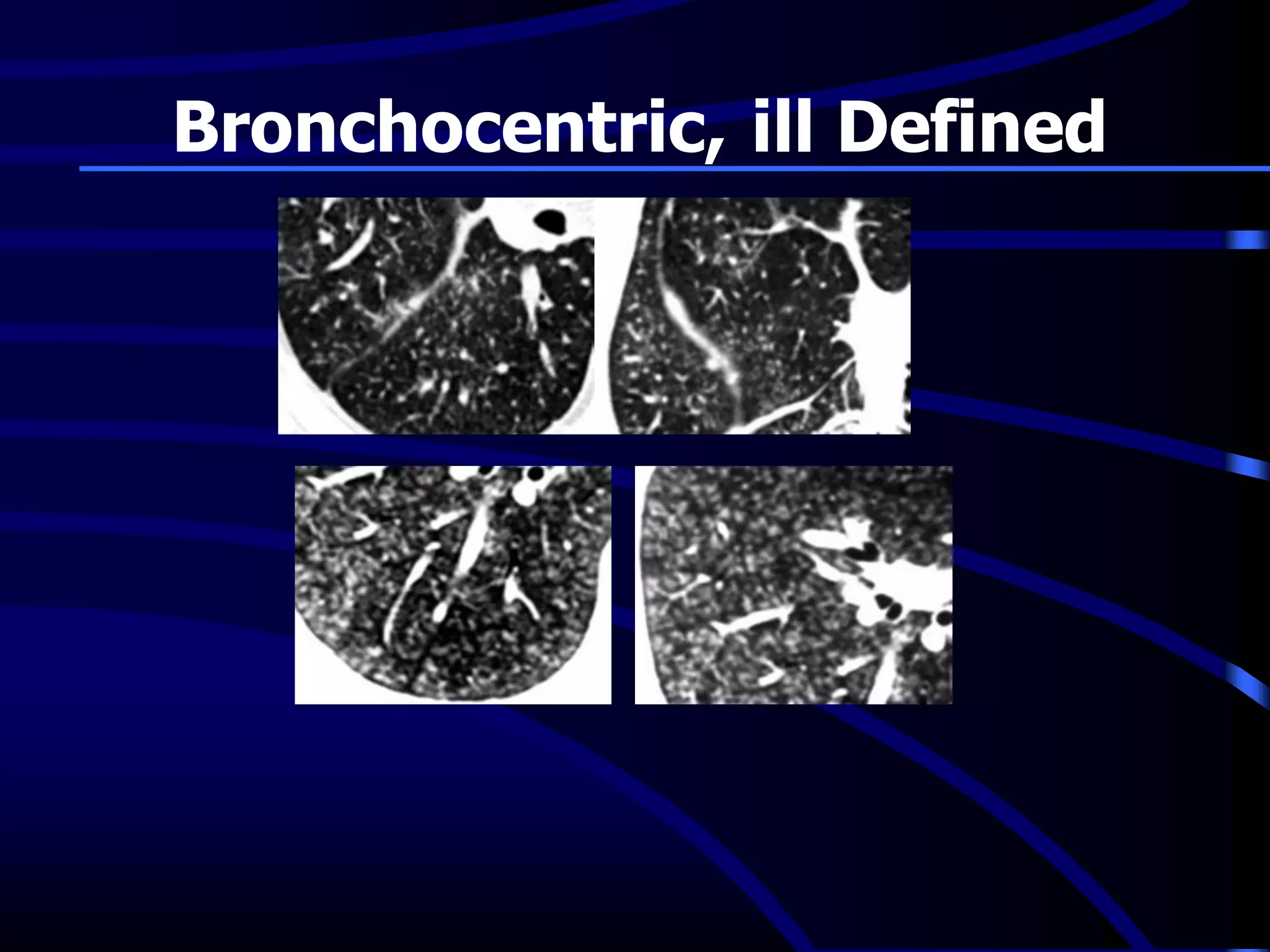 Bronchocentric, ill Defined
 