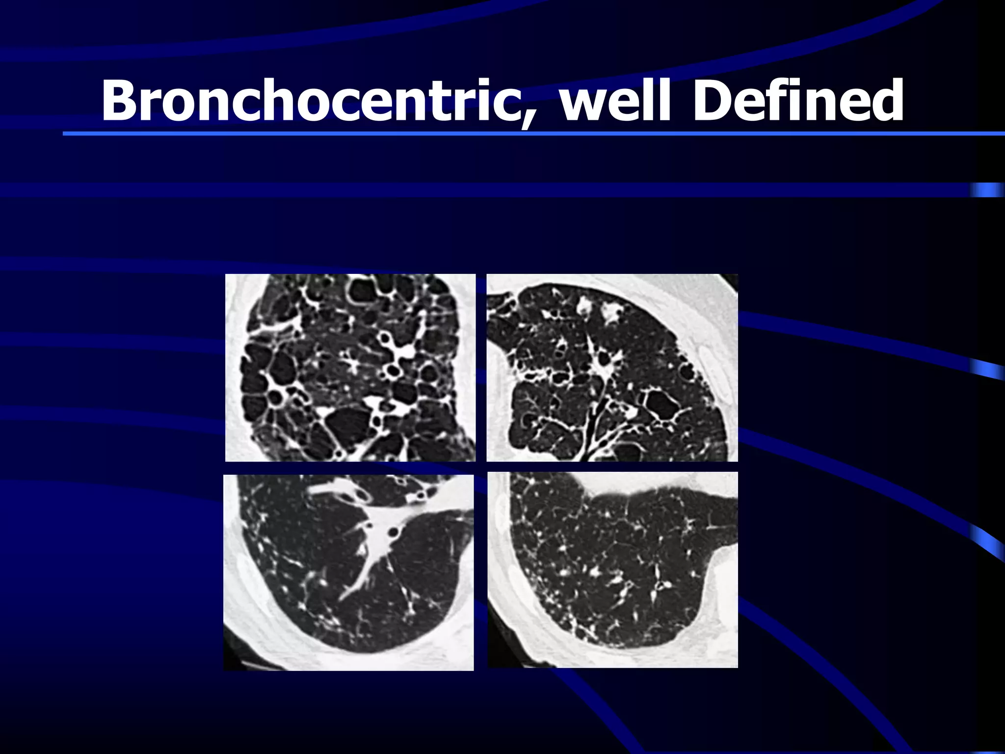 Bronchocentric, well Defined
 