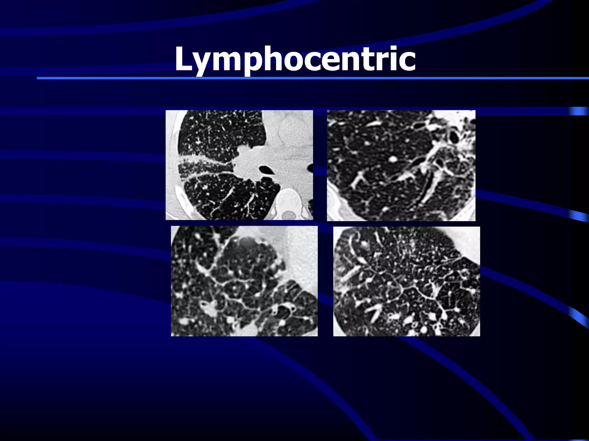 Lymphocentric
 