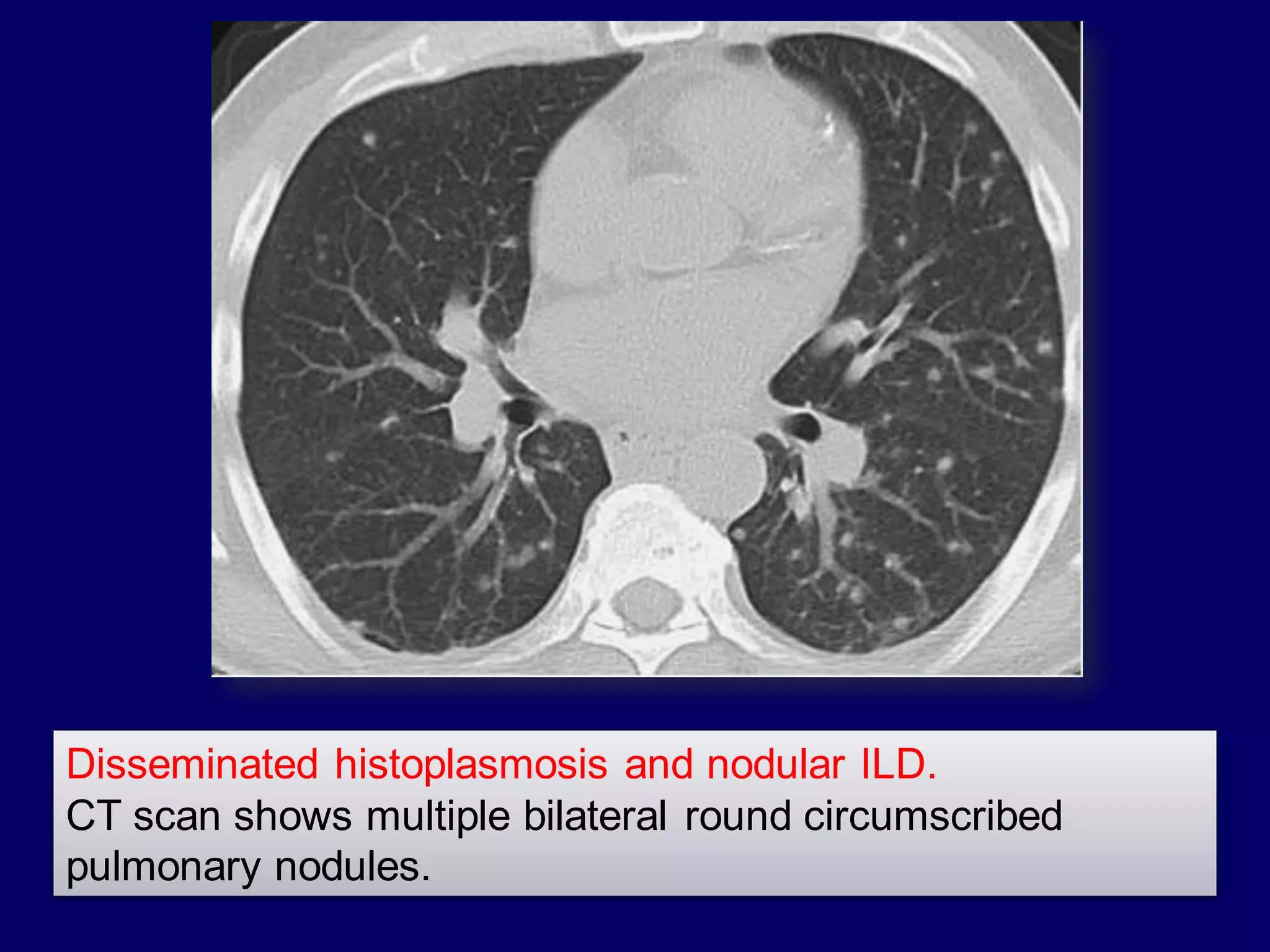 Disseminated histoplasmosis and nodular ILD.
CT scan shows multiple bilateral round circumscribed
pulmonary nodules.
 