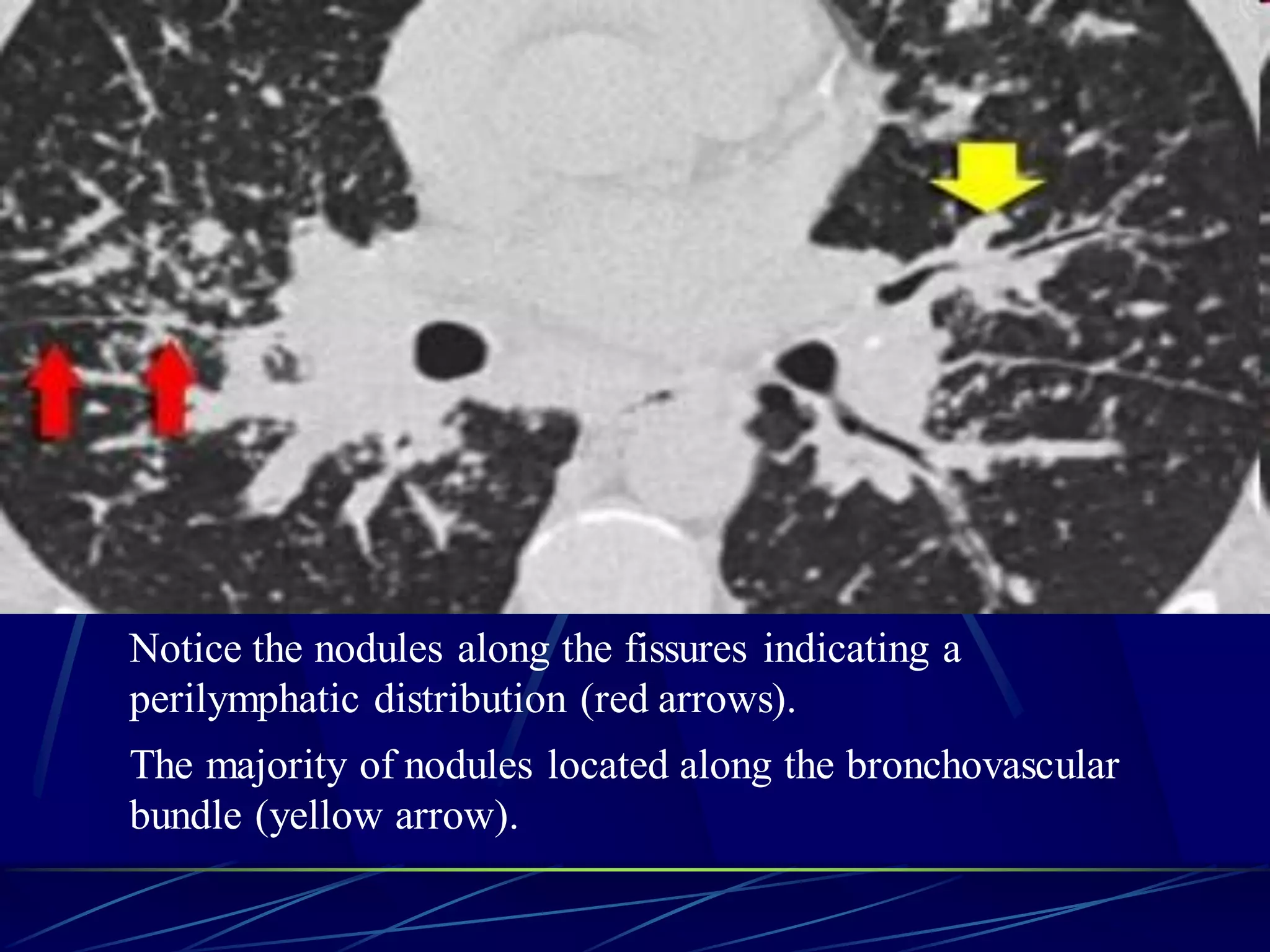 Notice the nodules along the fissures indicating a
perilymphatic distribution (red arrows).
The majority of nodules located along the bronchovascular
bundle (yellow arrow).
 