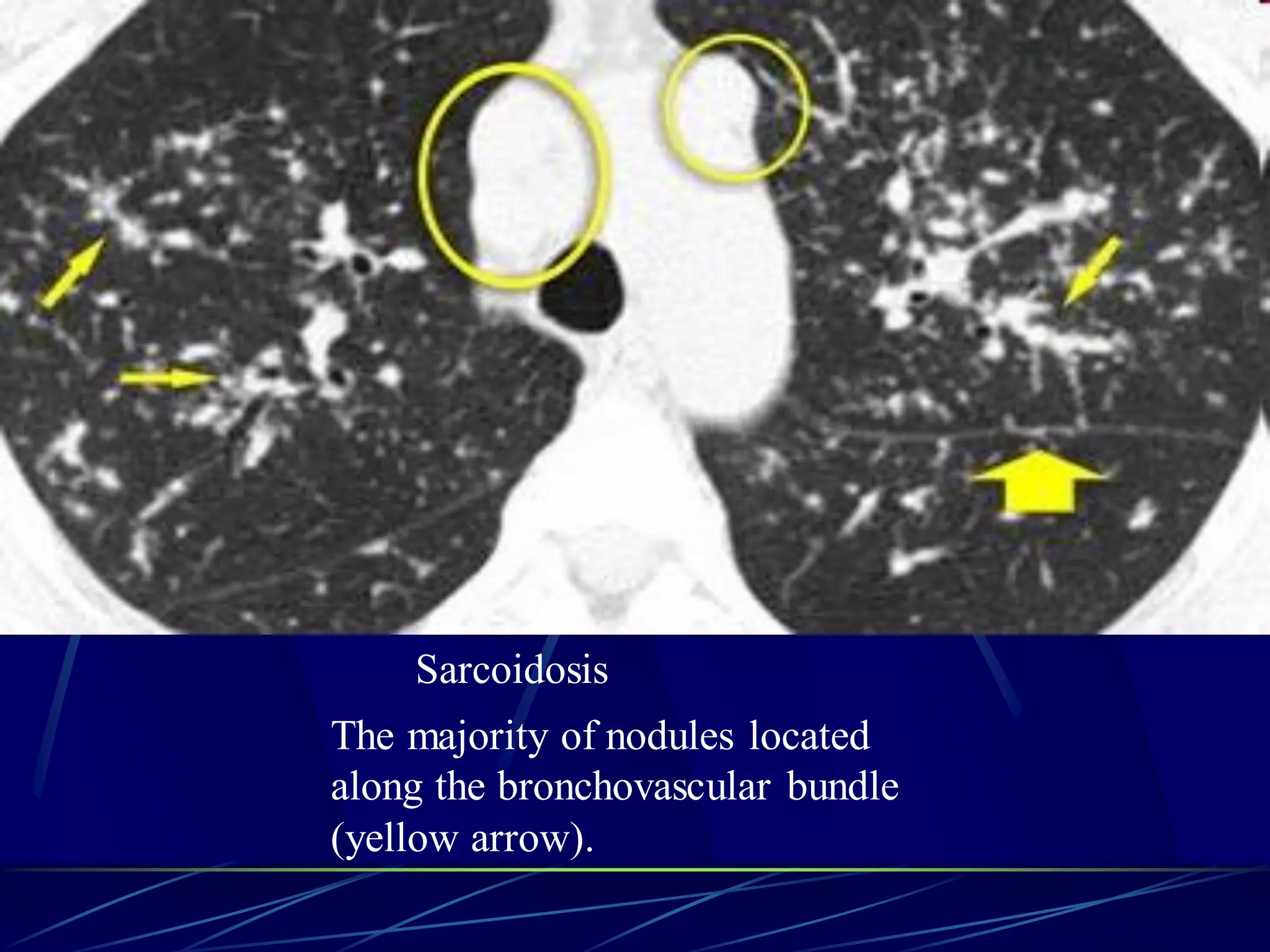 Sarcoidosis
The majority of nodules located
along the bronchovascular bundle
(yellow arrow).
 