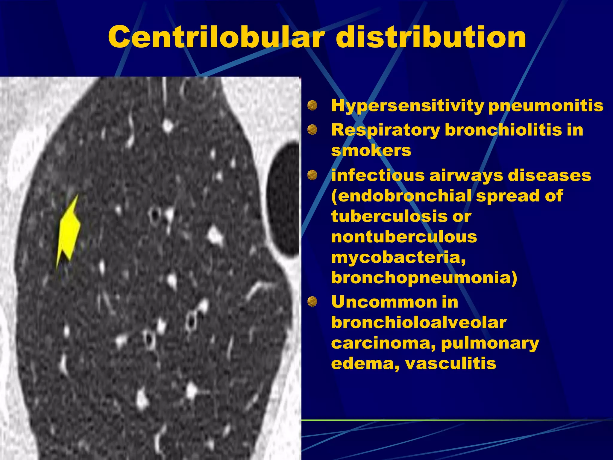 Centrilobular distribution
Hypersensitivity pneumonitis
Respiratory bronchiolitis in
smokers
infectious airways diseases
(endobronchial spread of
tuberculosis or
nontuberculous
mycobacteria,
bronchopneumonia)
Uncommon in
bronchioloalveolar
carcinoma, pulmonary
edema, vasculitis
 