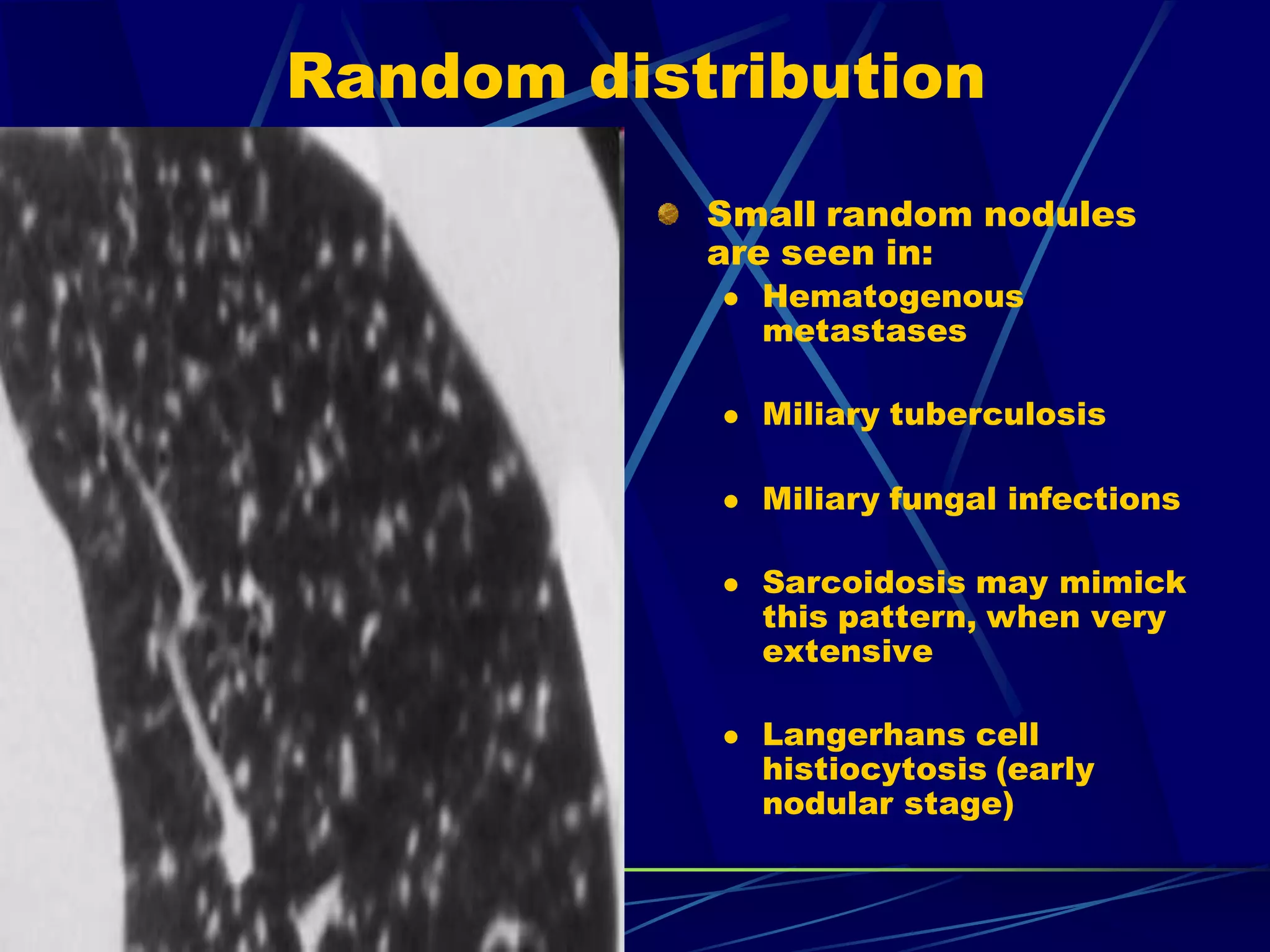 Random distribution
Small random nodules
are seen in:
 Hematogenous
metastases
 Miliary tuberculosis
 Miliary fungal infections
 Sarcoidosis may mimick
this pattern, when very
extensive
 Langerhans cell
histiocytosis (early
nodular stage)
 