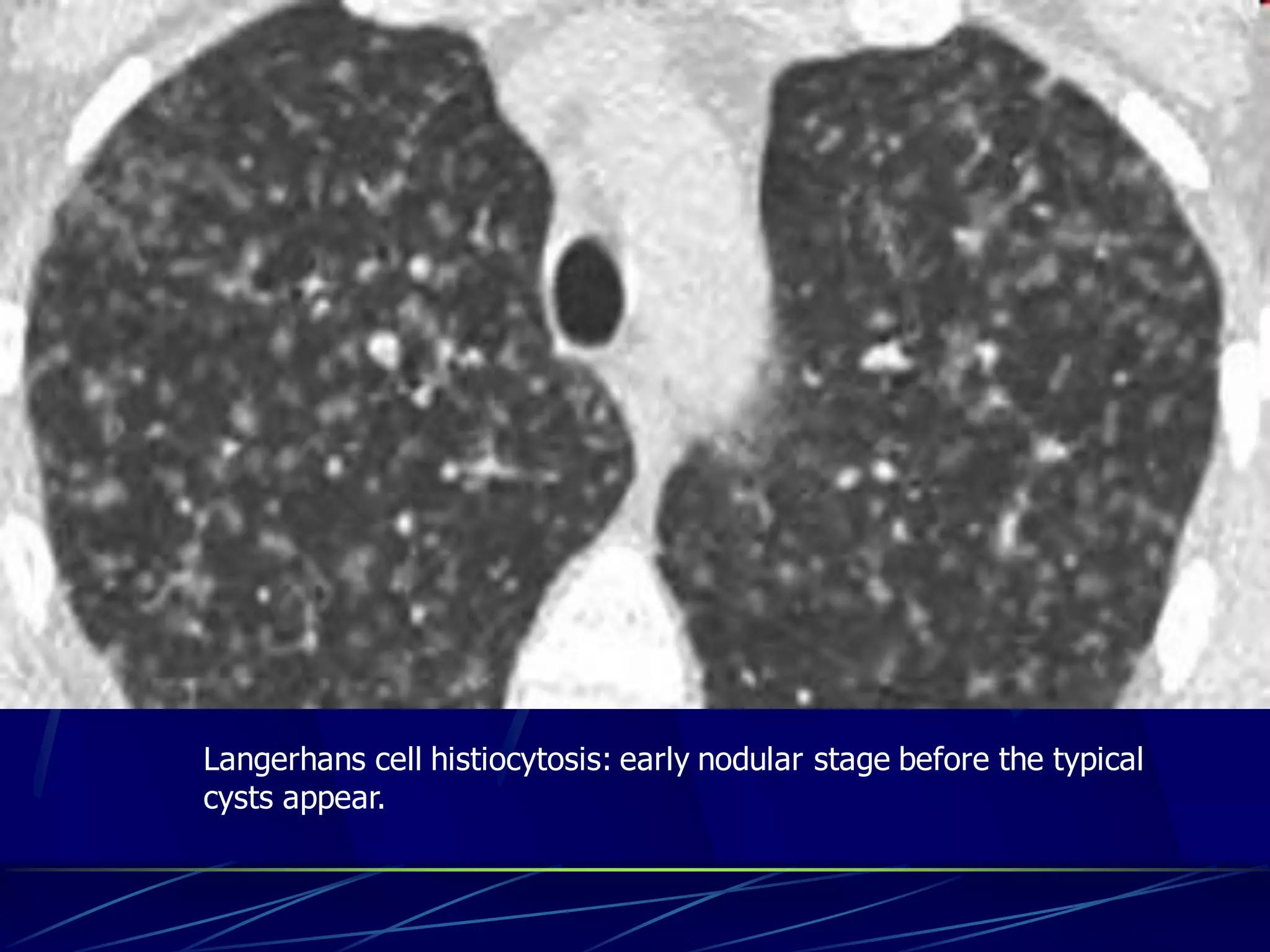 Langerhans cell histiocytosis: early nodular stage before the typical
cysts appear.
 