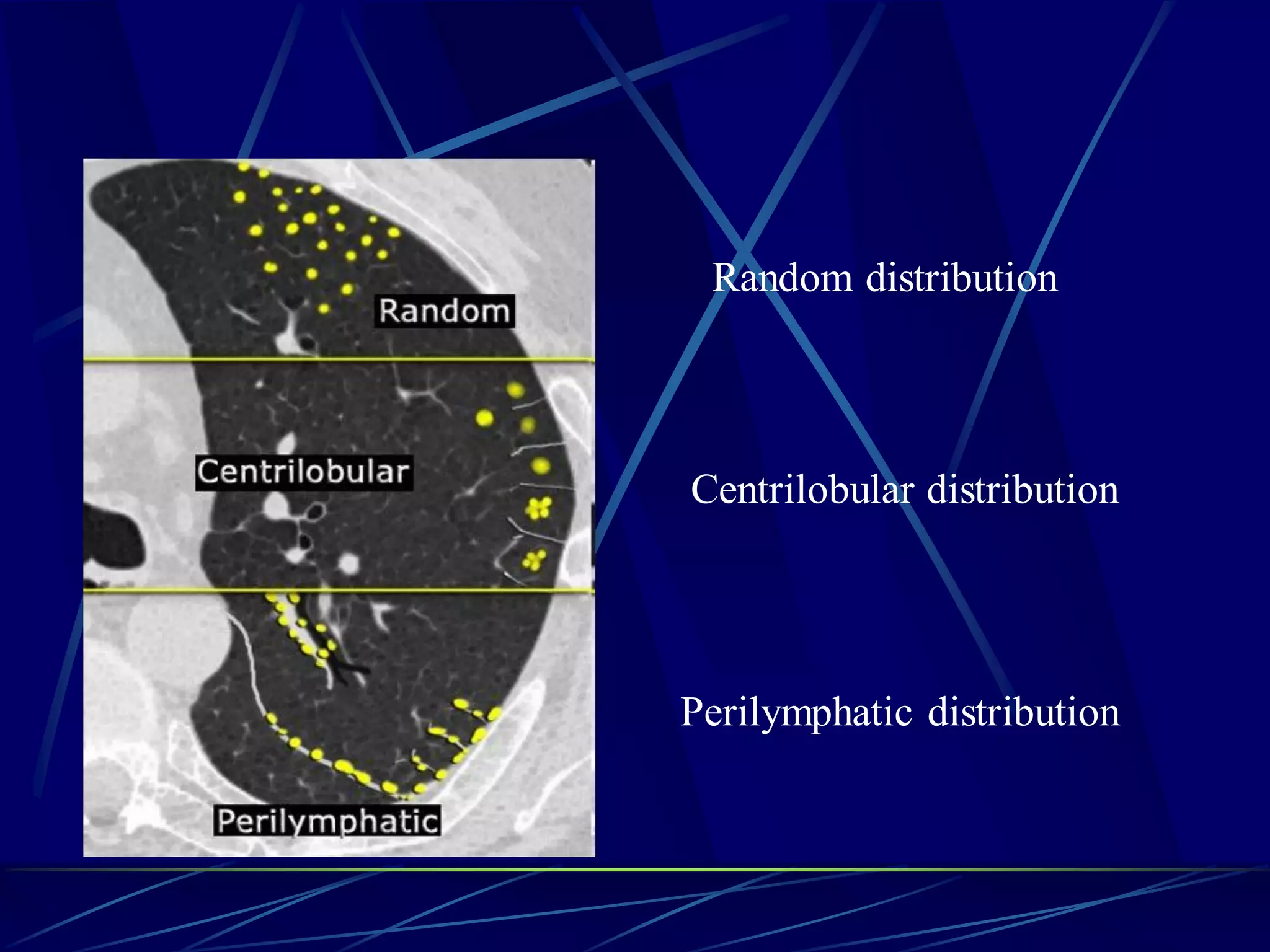 Perilymphatic distribution
Centrilobular distribution
Random distribution
 