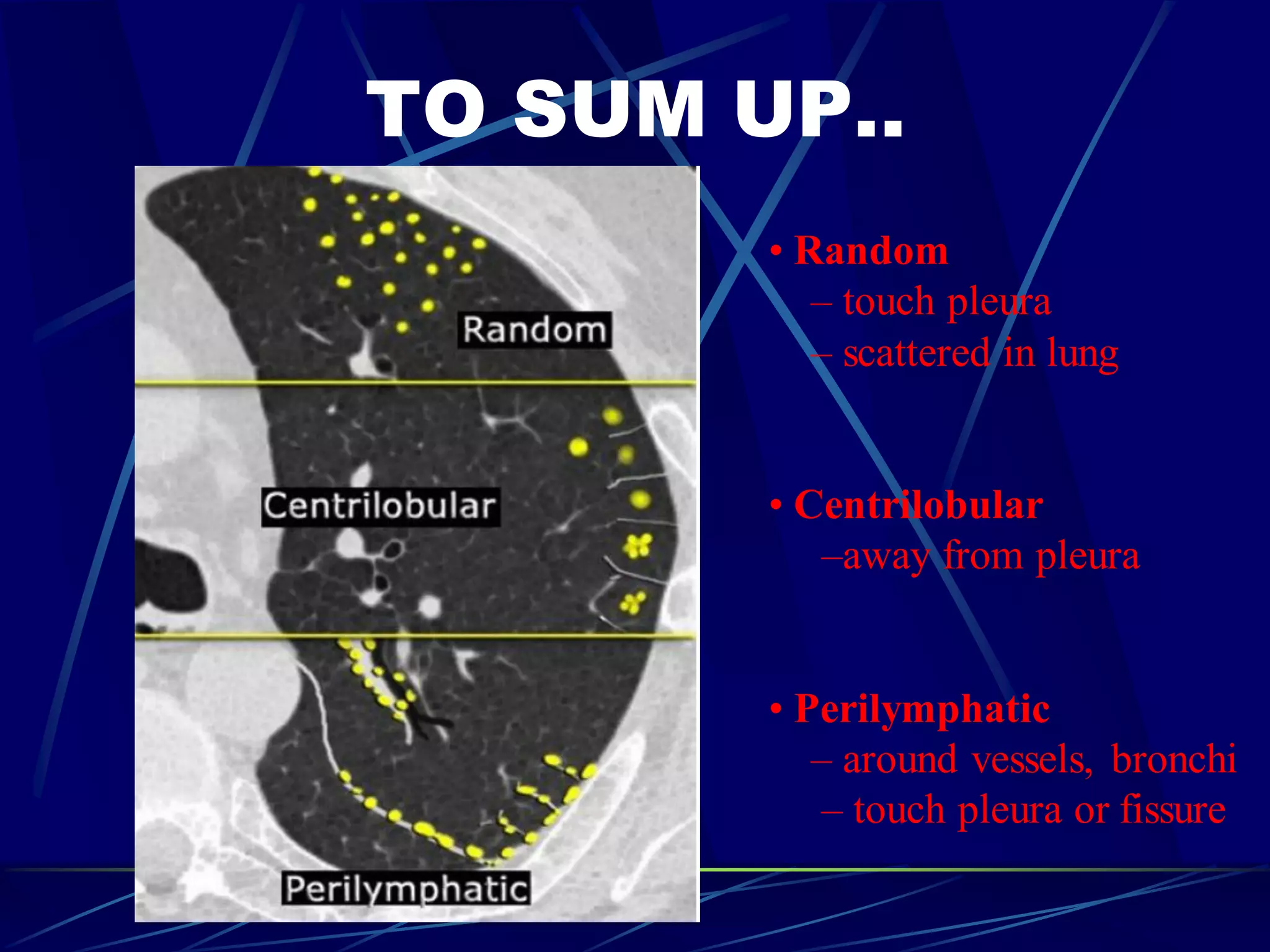 TO SUM UP..
• Random
– touch pleura
– scattered in lung
• Centrilobular
–away from pleura
• Perilymphatic
– around vessels, bronchi
– touch pleura or fissure
 