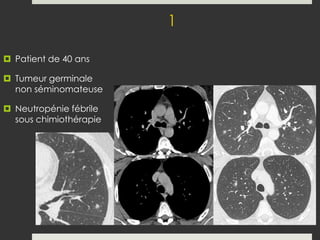 caractérisation des nodules pulmoanires.pdf
