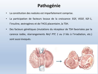 Pathogénie
• La constitution des nodules est imparfaitement comprise.
• La participation de facteurs locaux de la croissance: EGF, VEGF, IGF-1,
l’insuline, œstrogènes et de l’HCG placentaire ,la TSH.
• Des facteurs génétiques (mutations du récepteur de TSH favorisées par la
carence iodée, réarrangements Ret/ PTC 1 ou 3 liés à l’irradiation, etc.)
sont aussi évoqués.
 