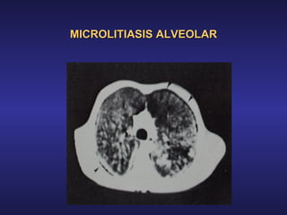 MICROLITIASIS ALVEOLAR 