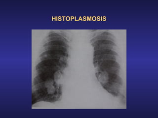 HISTOPLASMOSIS 
