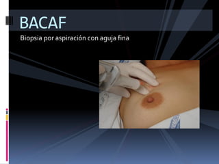 BACAF
Biopsia por aspiración con aguja fina
 