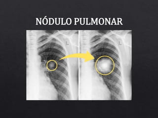 NÓDULO PULMONAR
 