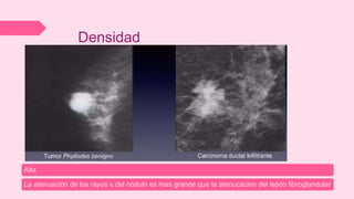 Densidad
Alta
La atenuación de los rayos x del nódulo es mas grande que la atenucacion del tejido fibroglandular
 
