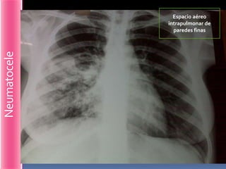 Espacio aéreo
              intrapulmonar de
                paredes finas
Neumatocele
 