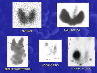 NORMAL                  BMN TOXICO




                    NODULO FRIO
BMN RETROESTERNAL                     NODULO TOXICO
 