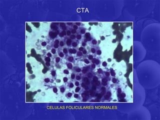 CTA




CELULAS FOLICULARES NORMALES
 