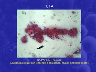 CTA




                         CA PAPILAR (tec pap)
Abundancia celular con tendencia a agrupacion, grupos sincitiales densos.
 