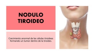 NODULO
TIROIDEO
Crecimiento anormal de las células tiroideas
formando un tumor dentro de la tiroides.
 