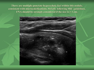 There are multiple punctate hyperechoic foci within this nodule,
consistent with microcalcifications. Strictly following SRU guidelines,
FNA should be strongly considered if the size is ≥ 1 cm.
 