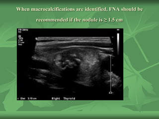 When macrocalcifications are identified, FNA should be
recommended if the nodule is ≥ 1.5 cm
 