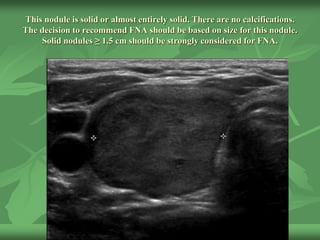 This nodule is solid or almost entirely solid. There are no calcifications.
The decision to recommend FNA should be based on size for this nodule.
Solid nodules ≥ 1.5 cm should be strongly considered for FNA.
 